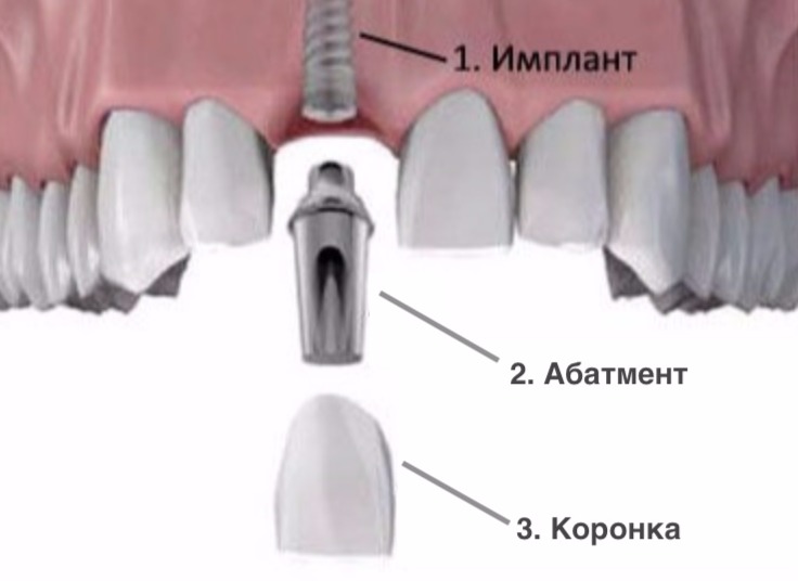 z-chogo-skladaetsya-zubnyy-implant