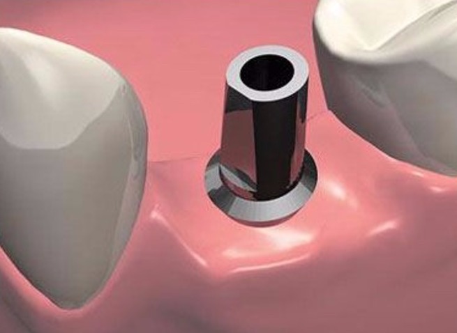 2-etap-implantacii-zuba