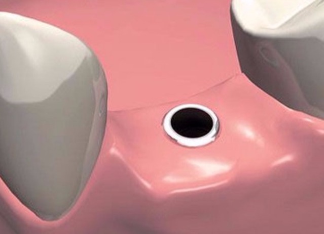 1-etap-implantacii-zuba